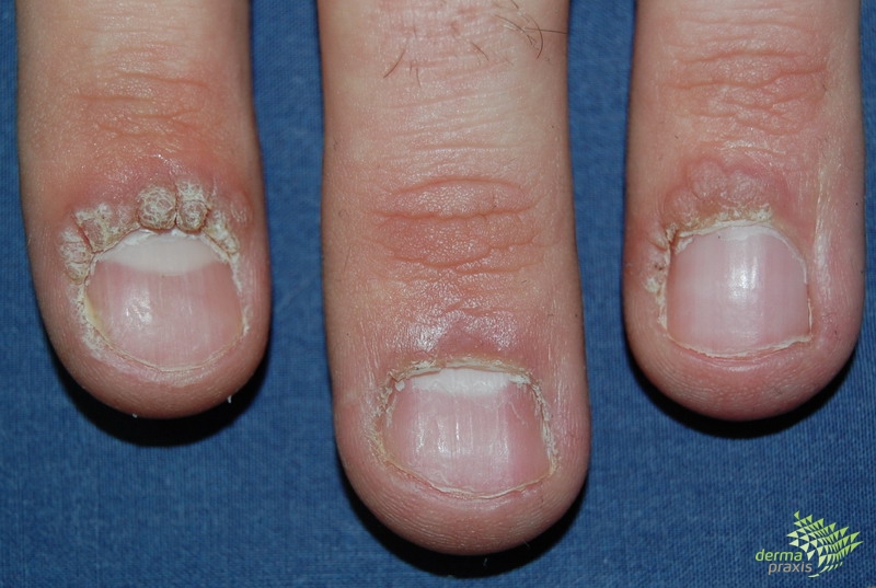 szemölcs vírus az ujjakon enterobiosis tünetei felnőtt nőknél